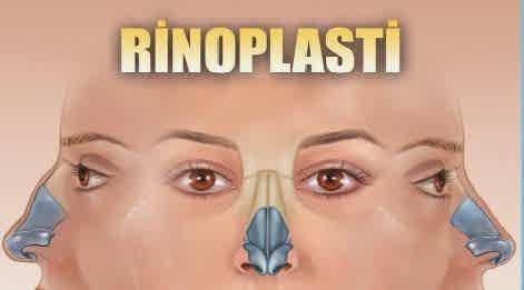 RİNOPLASTİ(ESTETİK BURUN AMELİYATI) SONRASI MALPRAKTİS İDDİASI İLE AÇILAN DAVADA ARAŞTIRILMASI GEREKEN HUSUSLAR.
