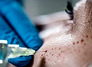 Güzellik Merkezinde PRP ve Dermapen ile cilt altı enjeksiyonu uygulanan olayda tazminat kararı