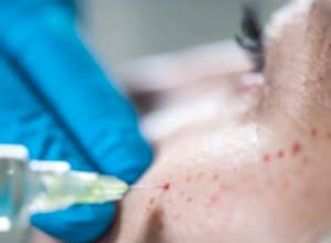 GÜZELLİK MERKEZİNDE YAPILAN DERMAPELLİ PRP VE BEN ALDIRMA İŞLEMİ SONRASINDA DAVACIDA MEYDANA GELEN KOMPLİKASYONLARIN HUKUKİ NİTELİĞİ (VAKA İNCELEMESİ)